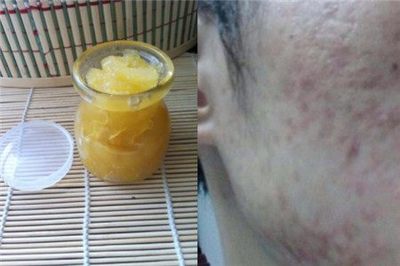 痘痘怎么能治好