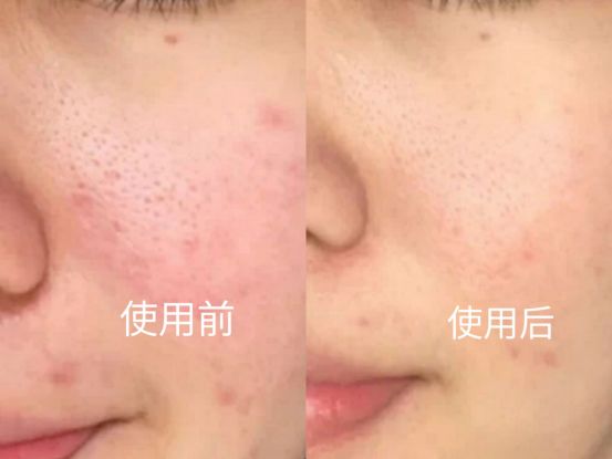 额头长闭口痘痘是什么原因