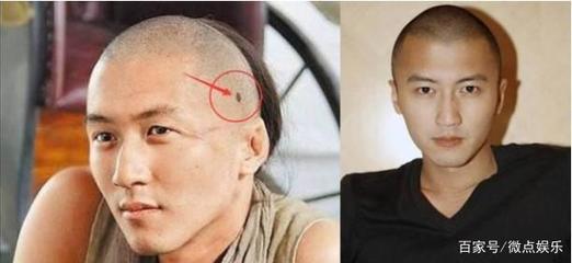 头上有黑痣是怎么回事