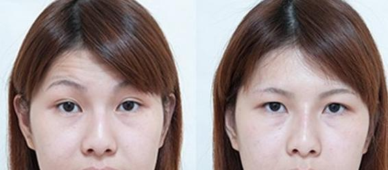 鱼尾纹除皱方法