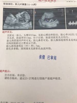 胎儿14周会有胎动吗