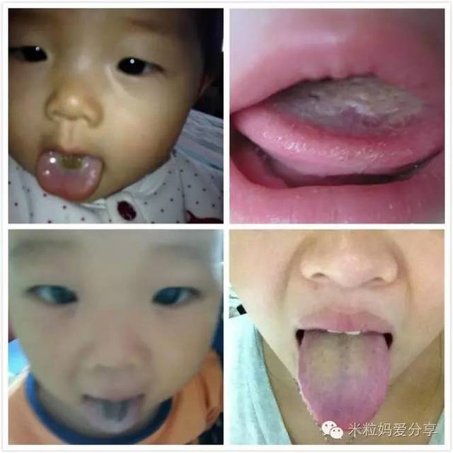 宝宝舌头发黑