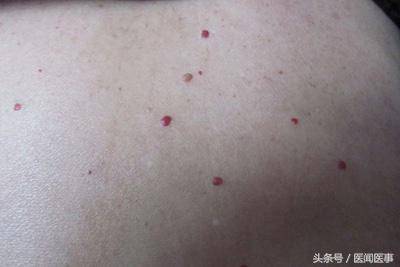 红痣是怎么回事