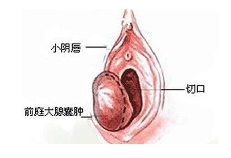 前庭大腺炎怎么治疗