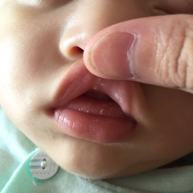新生儿白点点是什么