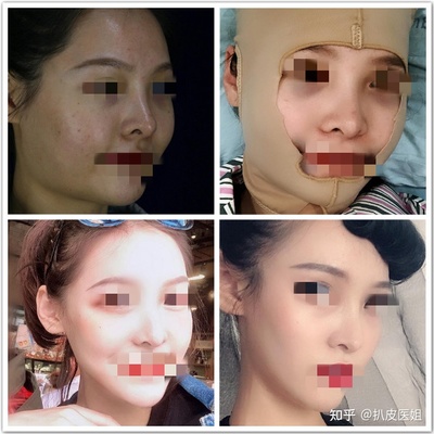 哪抽脂比较好
