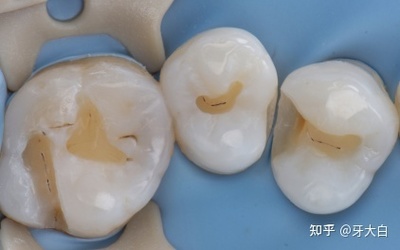 补牙后隐隐作痛