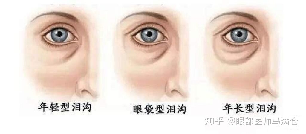 眼部脂肪填充