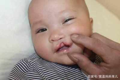 胎儿兔唇是什么原因造成的