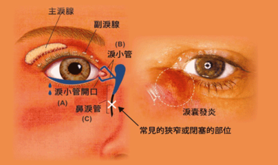 新生儿泪道堵塞的症状