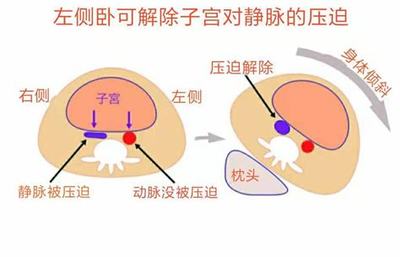 怀孕低血压对胎儿有什么影响