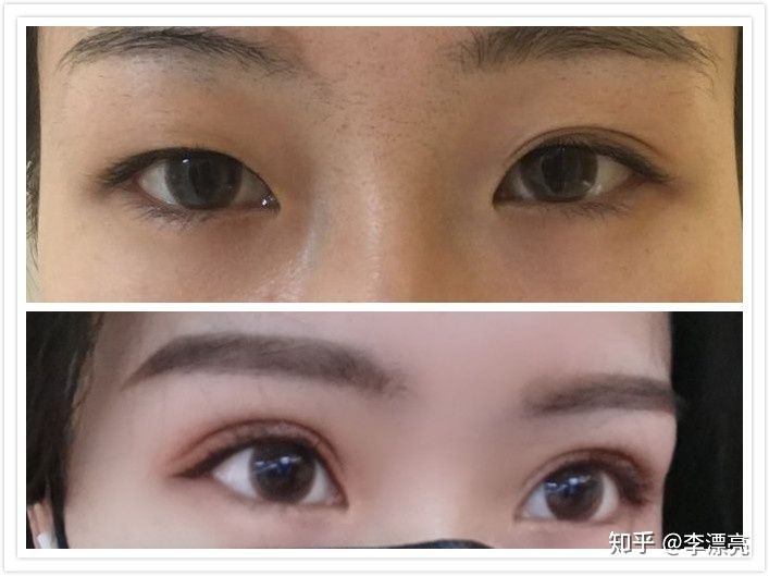 割双眼皮多久才能修复