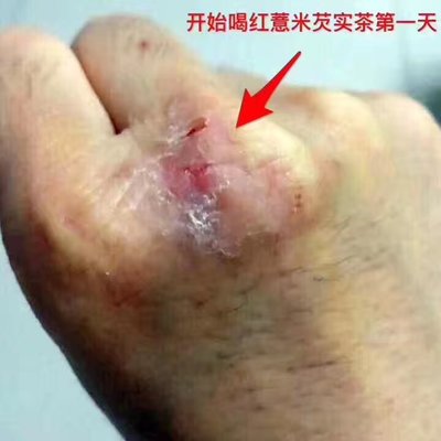 手心很烫是怎么回事