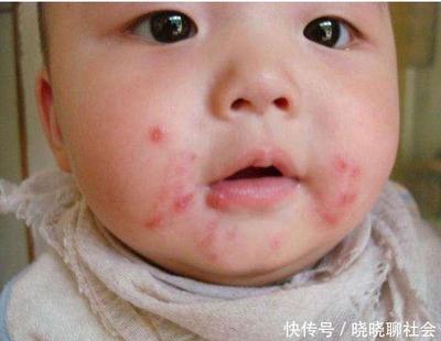 宝宝身上起痱子图片