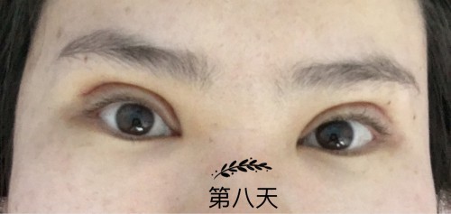 想做双眼皮