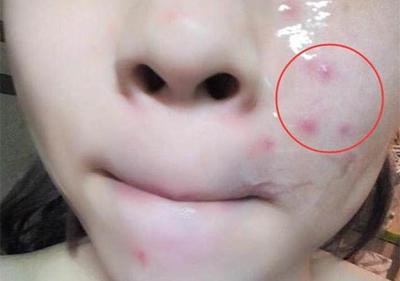 唇周痘痘用什么治疗方法