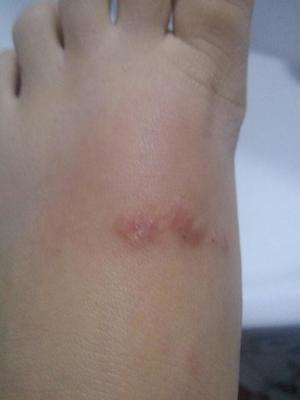 大腿长大痘痘怎么回事