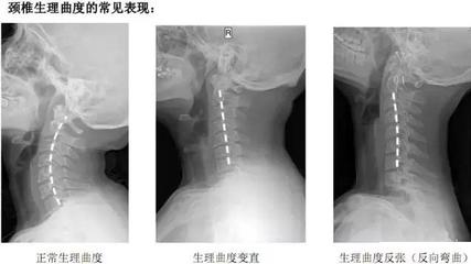 颈椎反张怎么治疗