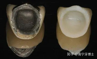烤瓷牙崩瓷怎么修复