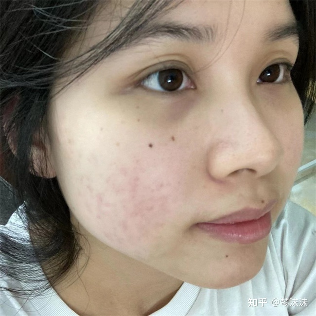 不长痘痘是什么情况