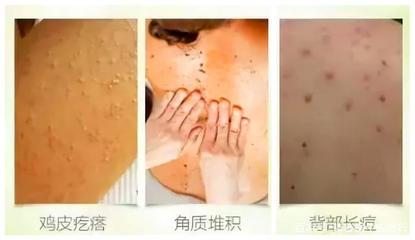 后背全身起痘痘是怎么回事