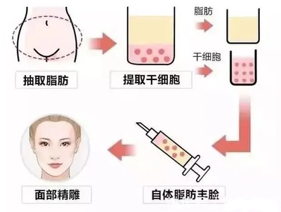 胶原蛋白填充法令纹