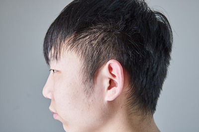 两鬓总是长痘痘是什么原因