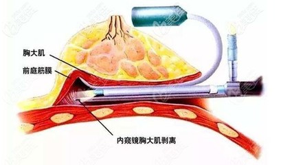 丰胸方法的价格是多少钱