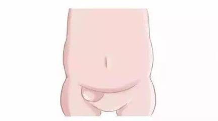 新生儿腹股沟疝