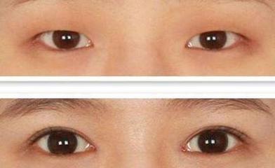 双眼皮为什么要开眼角