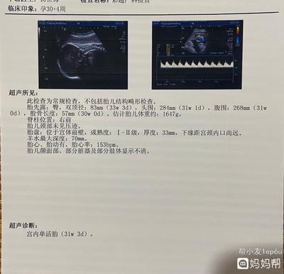 胎儿绕颈三周