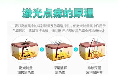 激光祛痣原理