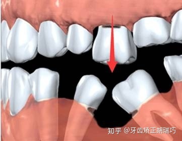 拔牙之后不镶牙可以吗