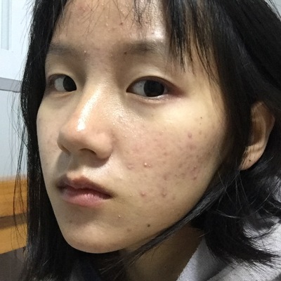 女生鼻子长痘痘怎么办