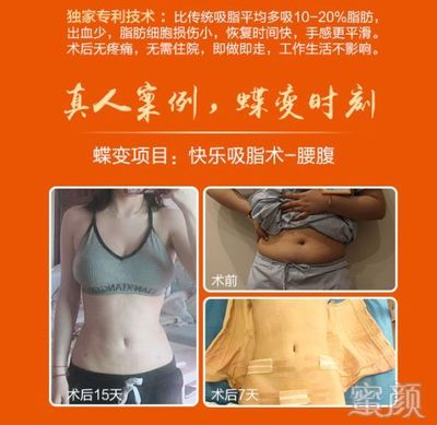 地区吸脂减肥