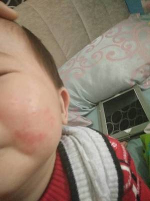 脸部反复过敏