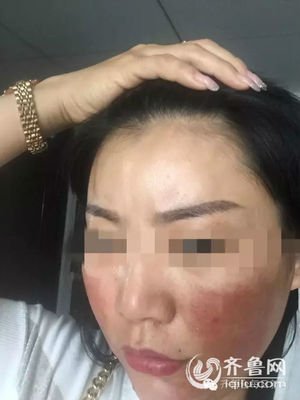打了玻尿酸要肿多久