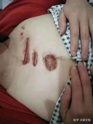 点痣用什么
