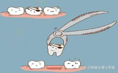 拔牙多久可以好