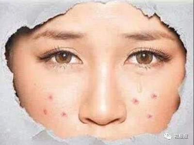 脸上用什么才能祛痘痘