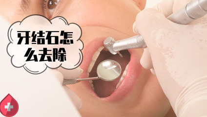如何去除牙垢,以及去除牙结石的最快方法