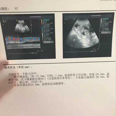 二胎怀孕40天小腹显怀