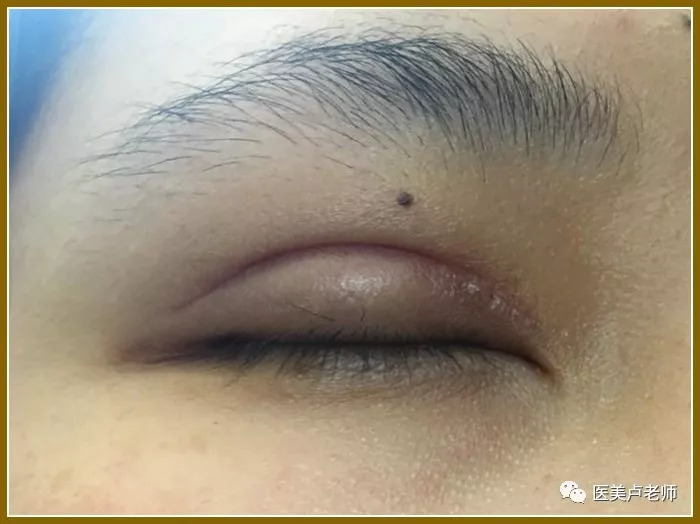 下眼皮凹陷修复哪里好