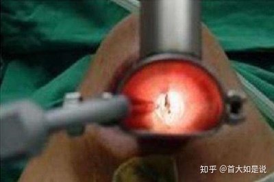 喉咙里有囊肿怎么治疗