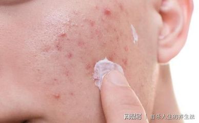 皮肤排毒会冒痘痘吗