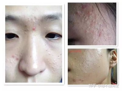 闭口痘痘粗糙