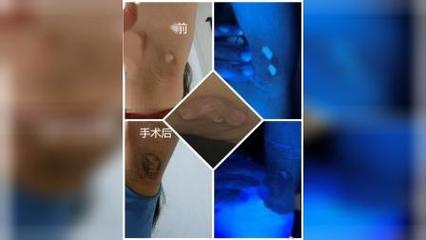 腋下有白斑是怎么回事
