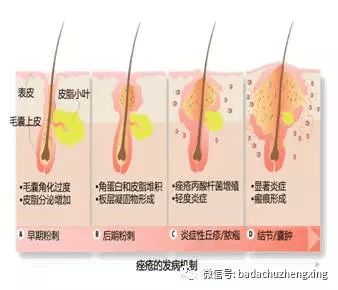 痘痘 激素水平