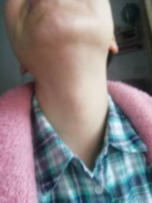 孕妇脖子上长痘痘怎么办