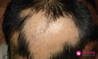 梦见自己掉了头发